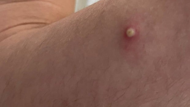 Síntomas de la viruela del mono en imágenes: si tienes una de estas lesiones ve al médico