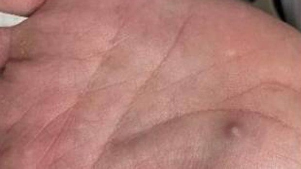 La OMS confirma más de 500 casos de la viruela del mono e insiste en que cualquiera se puede infectar