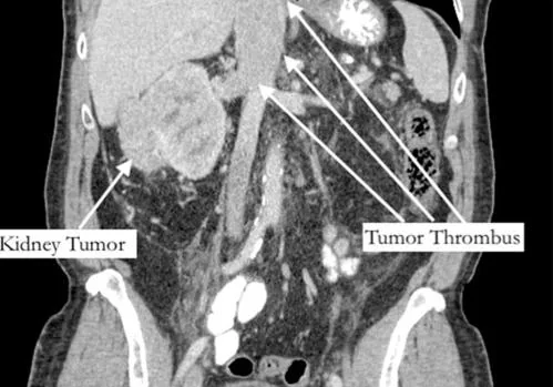 La tomografía computarizada de Bernstein de su torso, revelando su tumor renal y trombo tumoral