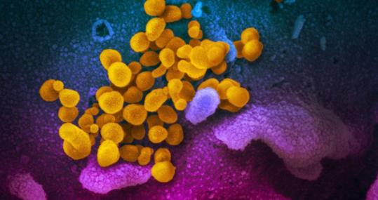 Aspecto del SARS-CoV-2 (en amarillo) desde un microscopio